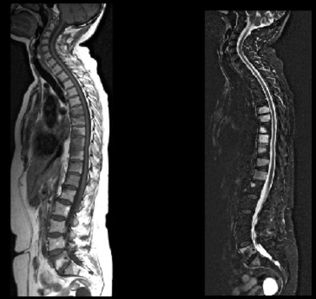 Fig. 9: SAPHO: MR images of the spine - T1W and STIR Sagittal.