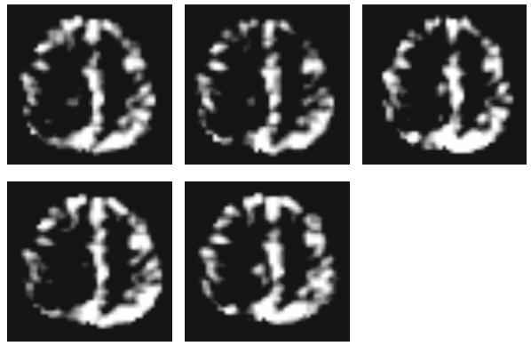Furthermore, since both fmri and DTI data include multiple channels (as explained later), we further propose a multi-channel CNNs (mcnns) to properly fuse information from all the channels of fmri or
