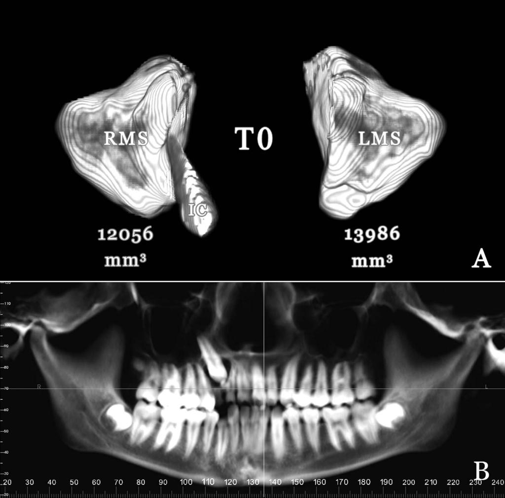 MAXILLARY SINUS RELATION TO IMPACTED CANINES 3 Figure 1.