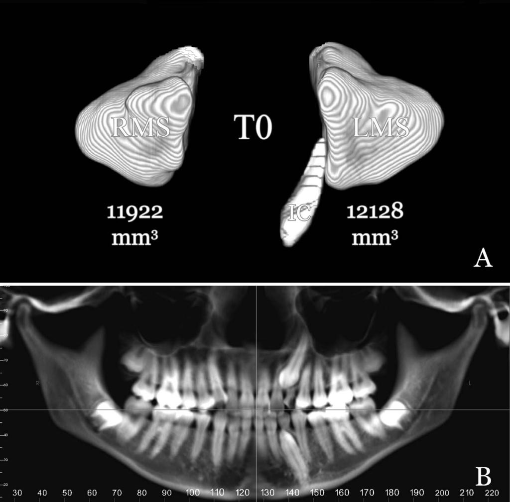 MAXILLARY SINUS RELATION TO IMPACTED CANINES 5 Figure 3.