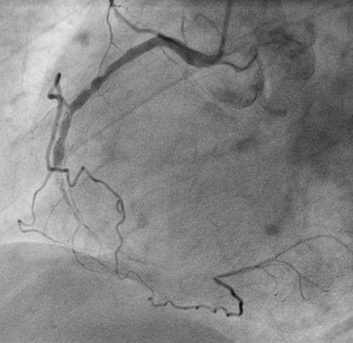 Clinical decision: PCI or CABG?