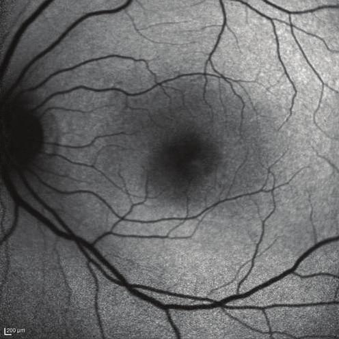 fluorescein angiography (FA) images of a 42-year-old female patient