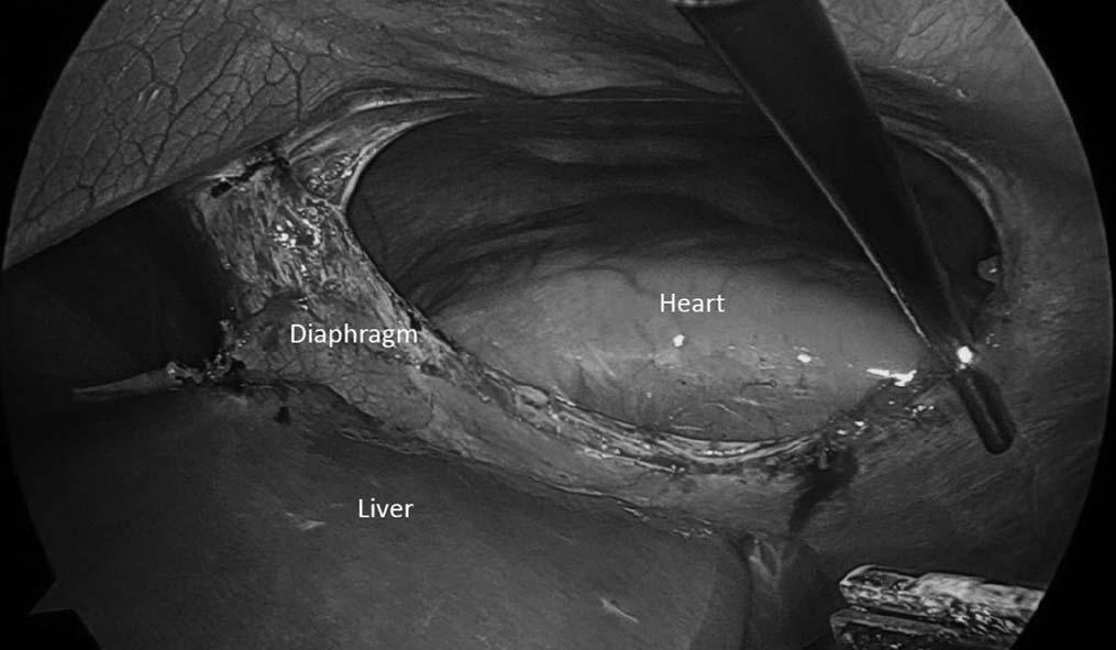 van Loenhout et al 5 were the first authors to review the literature on traumatic intrapericardial diaphragmatic hernia. They found 58 cases in addition to reporting a case.
