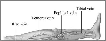 Deep Vein Thrombosis Presentation: DVT most often occurs in the lower extremities Embolus in up to 50% of cases Pain, swelling, and redness in the affected leg Diagnosis: D-dimer By-product of fibrin
