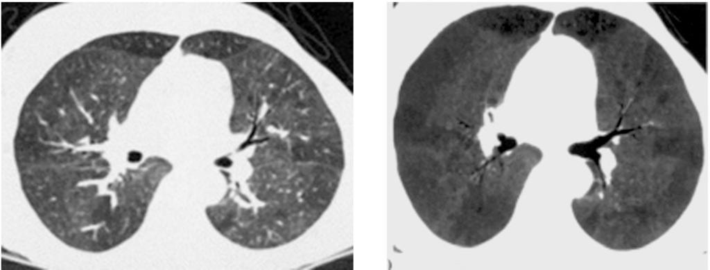 (2): A 36-year-old female with acute onset of dispend (A,B) axial view and mip reformatted image show diffuse ground-glass opacity widely spread across
