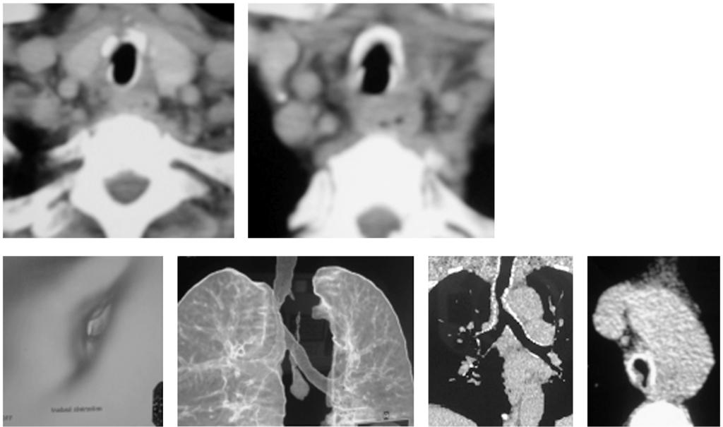 Case (13): Tracheomegaly: Incidental finding during HRCT of the chest done for bronchiectasis in a 5 3 year-old male patient.