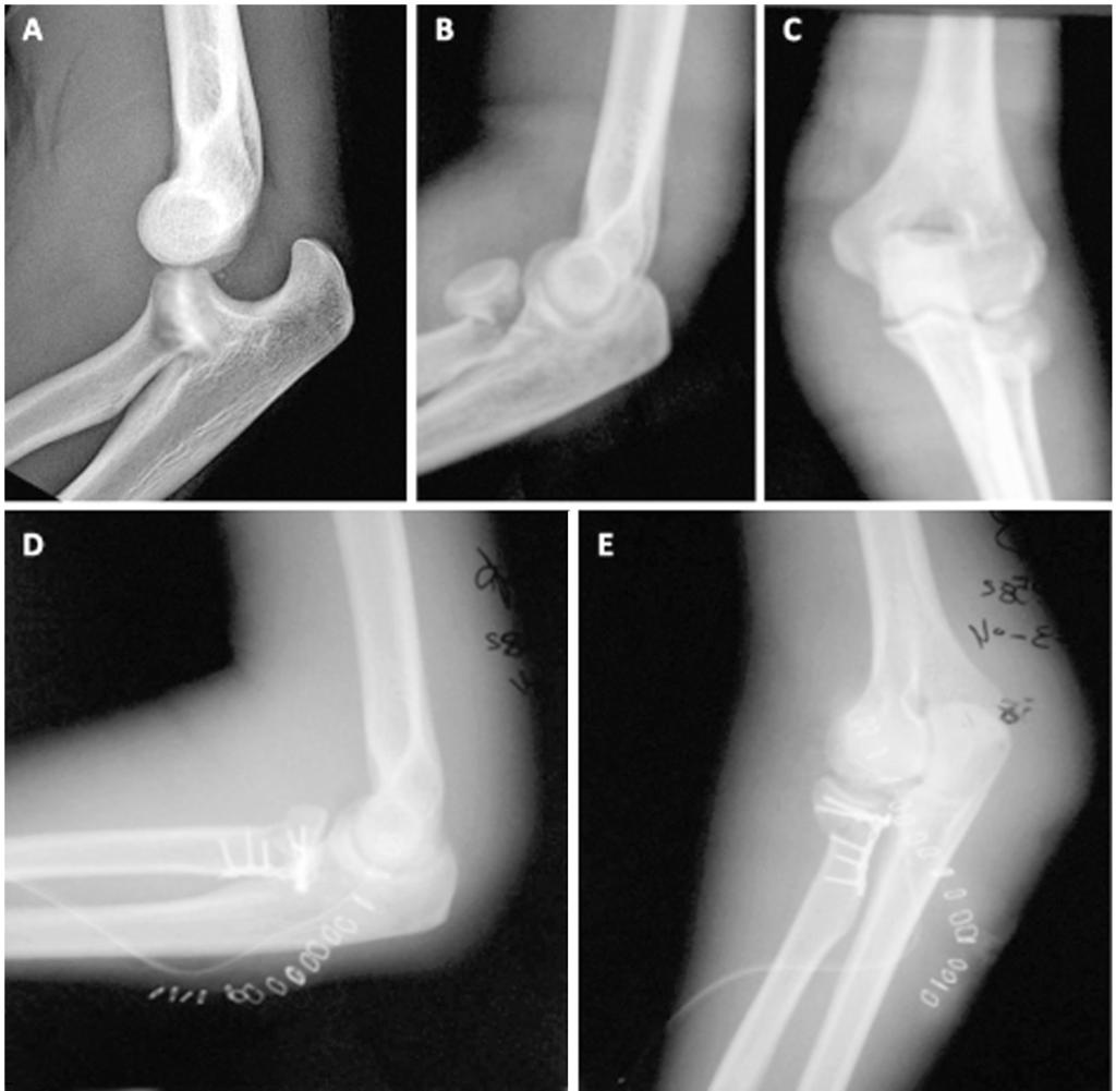 E,F,G & H: Nearly full R.O.M of injured elbow comparing with contra-lateral elbow. Fig. (4): Case No.