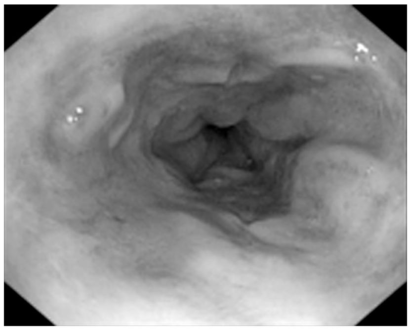 (2): Image of grade I oesophageal varices. Fig. (3): Image of grade II oesophageal varices.