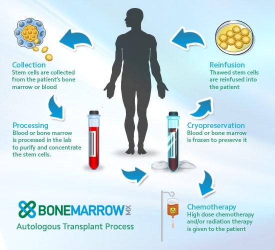 Autologous stem cell transplant If you have a solid cancer, such as breast cancer or lung cancer, a bone marrow or stem cell transplant may be included as part of your treatment.