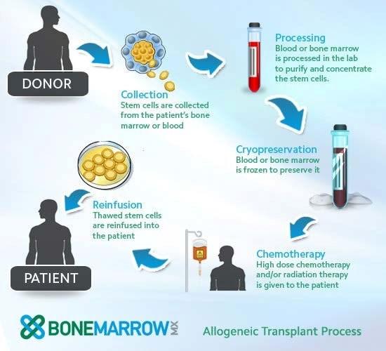 Allogenic stem cell transplant If a person s bone marrow has been affected by a disease, such as leukemia, bone marrow transplant can cure the disease by replacing the diseased marrow of the patient