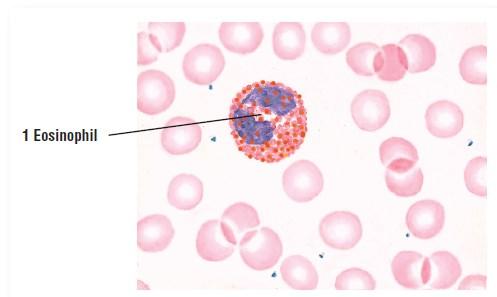 Granular leukocytes Eosinophils (1) are identified in a blood smear by their cytoplasm, which is filled with distinct,