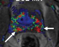 bright Diffusion-weighted imaging Apparent