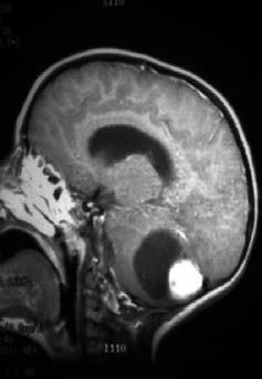 Top differential Diagnoses Medulloblastoma (PNET-MB) Pilomyxoid astrocytoma Pathology 15% of NF1 patients develop PAs, most