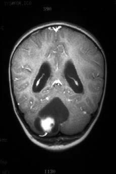 5-15 years of age Older than children with medulloblastoma Diagnostic Checklist Generally not a reasonable diagnostic