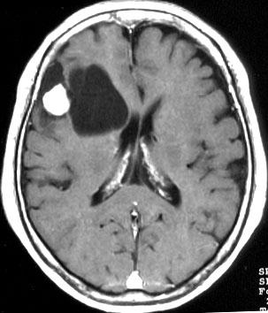 PLEOMoRPHIC XANTHOASTROCYTOMA Terminology Distinct type of (usually) benign supratentorial astrocytoma found almost exclusively in young adults Imaging Findings Supratentorial