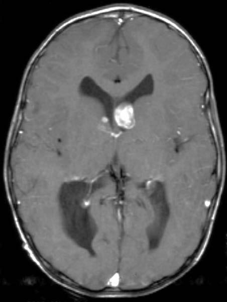OLIGODENDROGLIOMA Terminology Well-differentiated, slowly growing but diffusely infiltrating cortical/subcortical tumor Imaging Findings Best diagnostic clue: Partially Ca++ subcortical/cortical mass