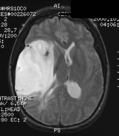ANAPLASTIC OLIGODENDROGLIOMA Terminology Oligodendroglioma with focal or diffuse histologic features of malignancy Imaging Findings Best diagnostic clue: Calcified frontal lob mass involving