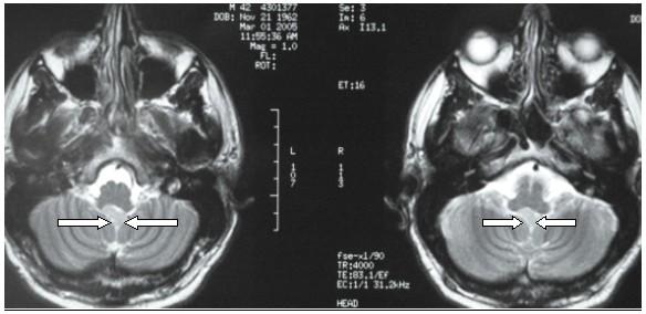 MRI Scan (Transaxial View-same patient as Figures 1, 4 & 5) 4 th Ventricular Ependymoma.