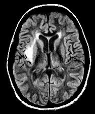 Oligodendroglioma Herpes encephalitis Status epilepticus Pathology Represents 25-30% of gliomas in adults 10-15% of all astrocytomas Diffusely infiltrating mass with blurring of GM/WM interface WHO