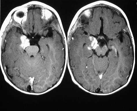 Diagnostic Checklist 4 th or lateral venricular hyperintense mass in an elderly male? Think sybependymoma!