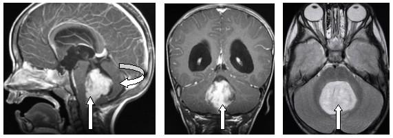 4 th V tumor arising from roof = PNET-MB 4 th V tumor arising from floor = ependymoma (Left): MRI Scan (Sagittal View-Gadolinium Enhanced) of a Young child with a large 4 th Ventricular