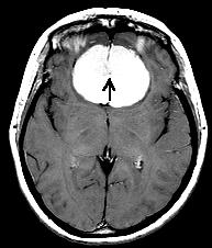 MENINGIOMA Imaging Findings Best diagnostic clue: Dural-based enhancing mass w/cortical buckling & trapped CSF clefts/cortical