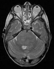 Posterior thalamus (30%) Enhancement: Variable and may not be present Calcification: Less than 4% Differential diagnosis a.