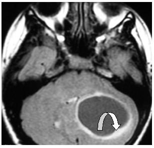 Pearls in the Diagnosis of Hemangioblastoma Sixty percent are intramedullary; 40% are extramedullary but intradural Thirty percent have Hippel-Lindau disease Thoracic location in 50% and cervical