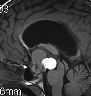 Cysts of this size cause considerable pressure on the Brain Stem which can threaten the patient's life if left untreated.