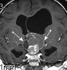 enhancing extra-axial mass with dural attachment, +/- skull erosion May mimic meningioma, but without Ca++ or hyperostosis Typically involve falx,
