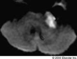 Morphology: Lobulated, irregular, cauliflower-like mass with fronds FLAIR: Usually doesn t completely null Restricted diffusion yields high signal Top Differential Diagnoses Arachnoid cyst