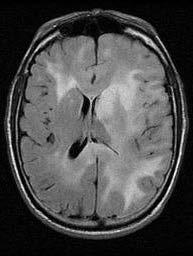 Lymphoma Pathology Underlying brain architecture preserved Usually WHO grade III Clinical Issues Peak incidence between 40-50 years Poor prognosis Diagnostic Checklist Rare diffusely infiltrating