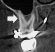 5 ys in girls) may have detrimental effects on the supporting alveolar bone (dehiscences)