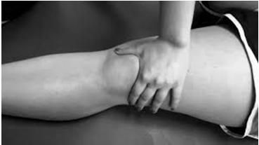 PFS - History Typically atraumatic Sometimes describe remote injury or fall Can describe knee giving way or buckling But not a true dislocation or subluxation Pain with stairs Pain with prolonged