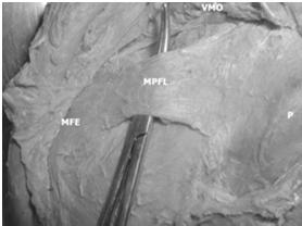 MPFL 3 Deep MCL MPFL Inserts on superomedial patella, 6mm below superior pole Origin entire height of anterior aspect of medial femoral epicondyle Anterior and distal to add tubercle Posterior and