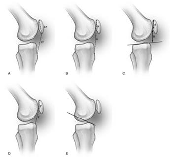Imaging Radiographs AP Lateral Patellar Height Insall-Salvati Modified Insall-Salvati Blackburne-Peel Caton-Deschamps Blumensaat line Imaging MRI