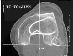 origin Identifying chondral injuries/loose bodies Typical bone bruise pattern Imaging Dejour et al 1994 CT and Radiographic Factors contributing to