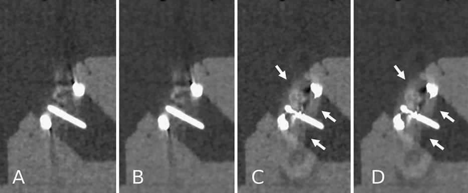 Int J Cardiovasc Imaging (2012) 28:2099 2108 2105 Fig. 3 CT image reconstructions of Medtronic Hall tilting disc (Medtronic Inc.