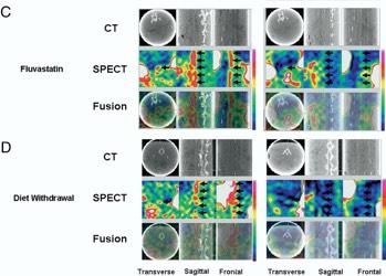 Molecular Imaging of Matrix Metalloproteinase in Atherosclerotic Lesions Resolution With Dietary Modification and Statin, (99mTc conjugated to the broad-spectrum, MMP-inhibiting macrocyclic compound