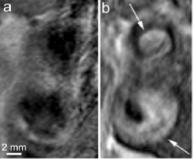 Circulation 2003 " PET-CT PET-MRI: Carotid artery imaging of a pt with atherosclerotic disease using