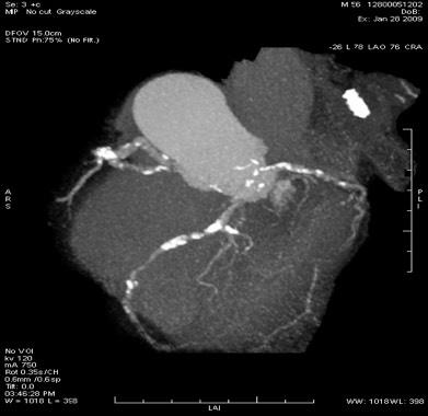 Asymptomatic preclinical type of CAD Example of a 56-year-old asymptomatic man w/ an intermediate SCORE of 5%. Extensive calcification of the three coronary vessels CACS 1940 A!