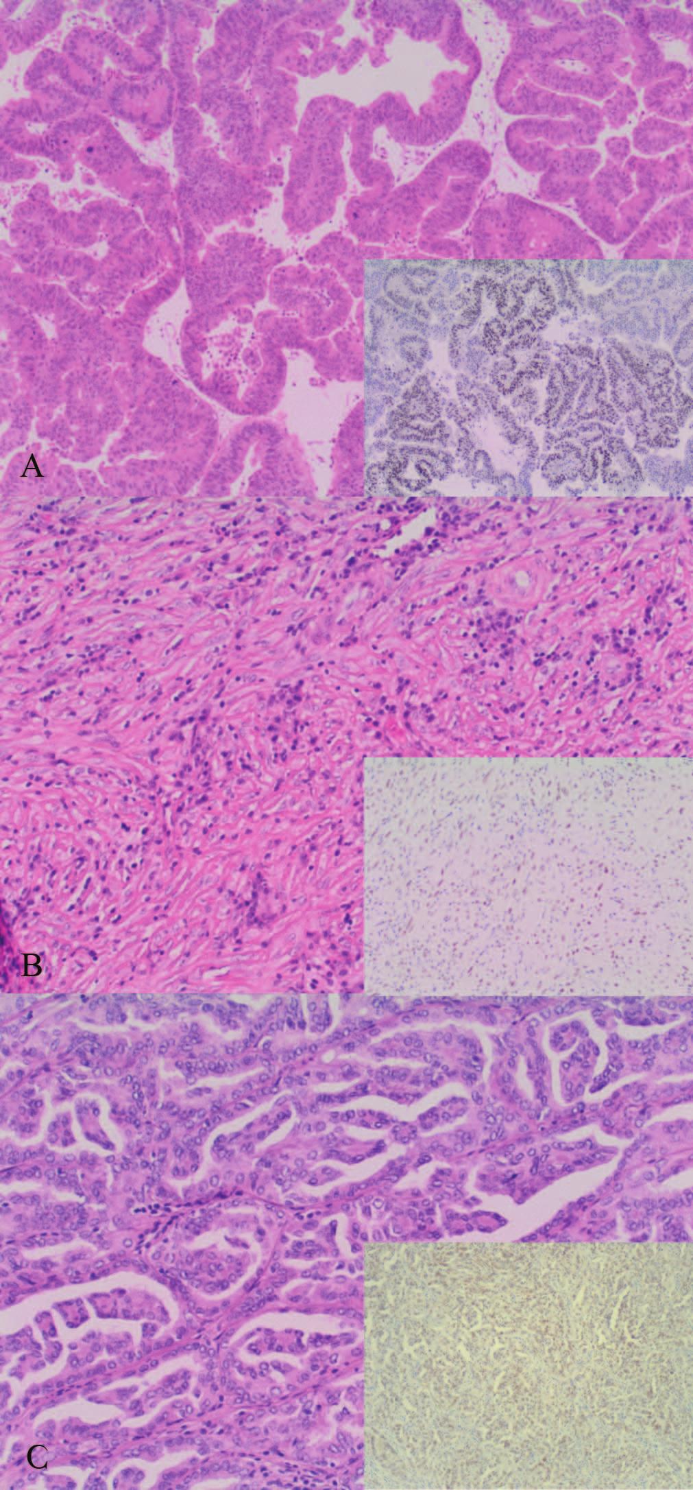 Figure 2. A, SATB2-positive ovarian mucinous adenocarcinoma. B, SATB2-positive desmoplastic mesothelioma.