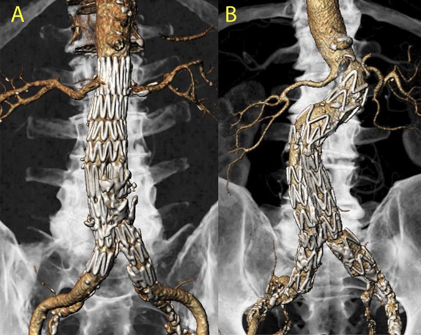JOURNAL OF VASCULAR SURGERY Volume 52, Number 4 van Keulen et al 1083 Fig 2. A, A symmetrically deployed stent graft is shown in a straight aneurysm neck.