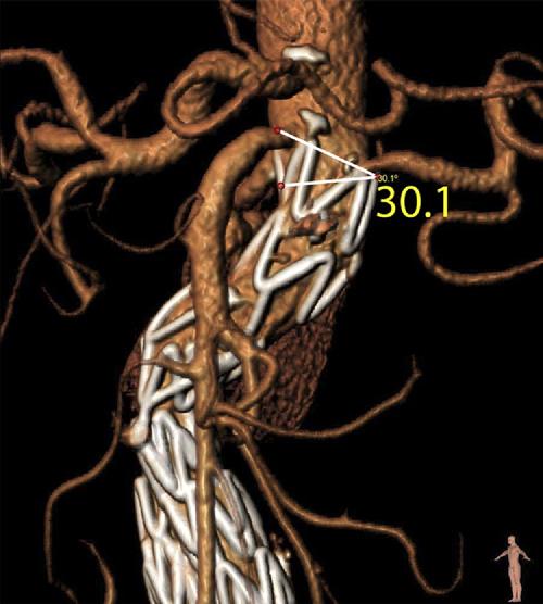 The stent graft is placed asymmetrically compared with the aneurysm neck. The asymmetric placement of stent grafts may have serious consequences. Fig 4.