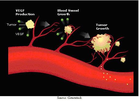 Angiogenesis Taxol + Avastin in metastatic