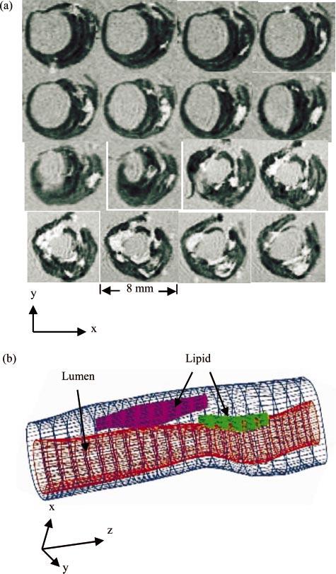 METHODS: THE 3D MRI-BASED COMPUTATIONAL MODEL Cases Studied and Fixation Procedures A 3D MRI data set obtained from a human carotid plaque ex vivo consisting of 64 two-dimensional slices with high