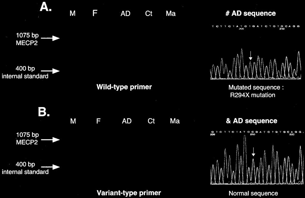 Each sample was separately amplified with the wild type (W) primer (A) and the variant type (V) primer (B). Coamplification of an internal standard fragment was also performed in each PCR reaction.