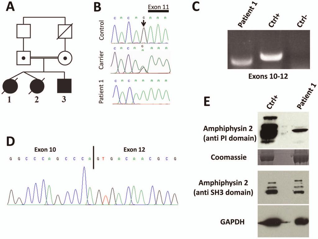 Figure 1. Human BIN1 mutation of the exon 11 acceptor splice site and impact on splicing. (A) Pedigree and (B) Chromatopherogram. Patients 1 and 3 are homozygous for the IVS10-1G.