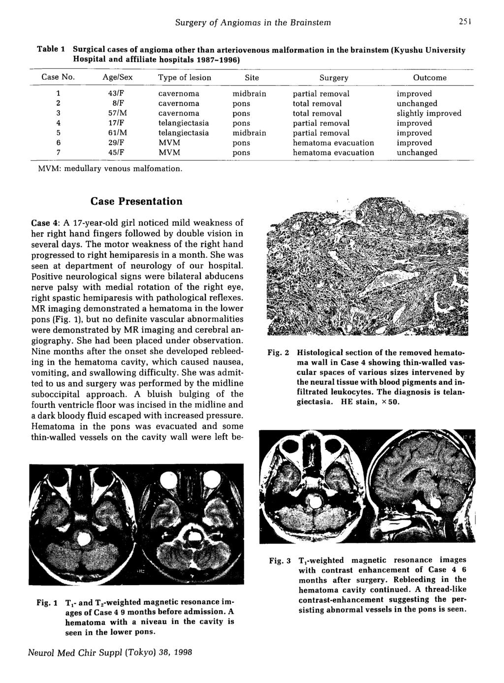 Surgery of Angiomas in the Brainstem 251 Table 1 Surgical cases of angioma other than arteriovenous malformation in the brainstem (Kyushu University Hospital and affiliate hospitals 1987-1996) MVM: