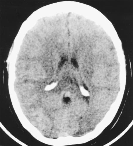 A B Figure 1. Axial CT and MRI scans of patient 1 s brain. (A) The noncontrast CT image shows a vague area of hyperdensity (arrow) in the right occipital lobe.